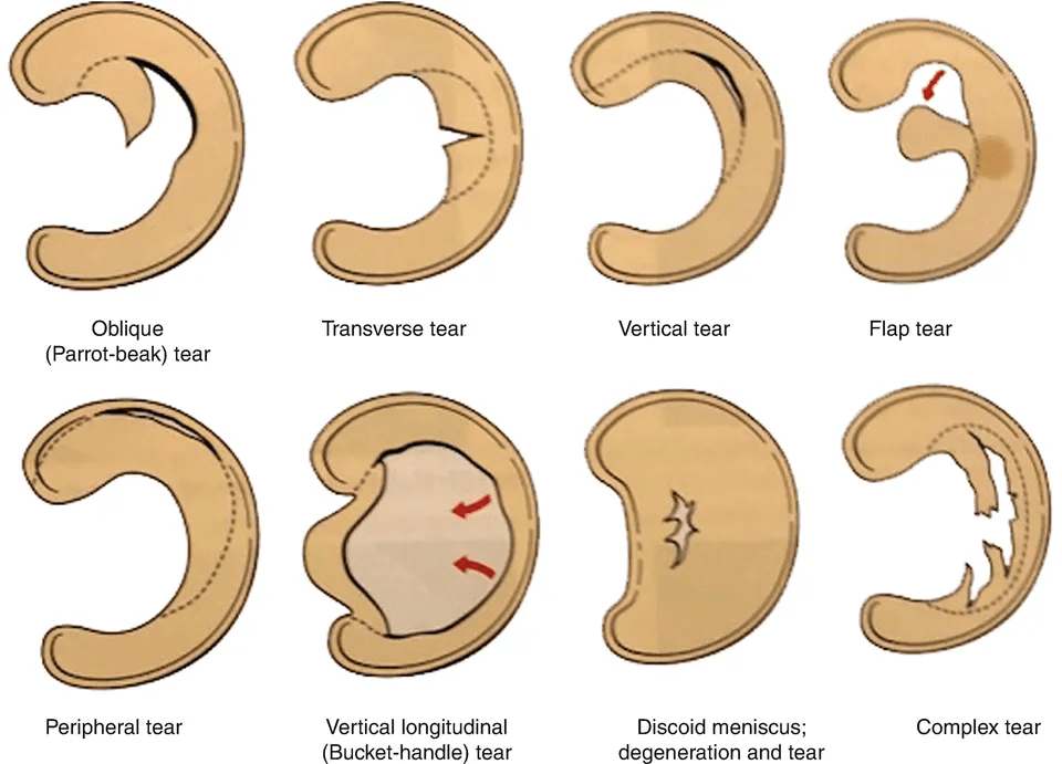 Complex deals meniscus tear